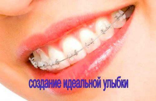 Ортодонтия - установка детских брекетов